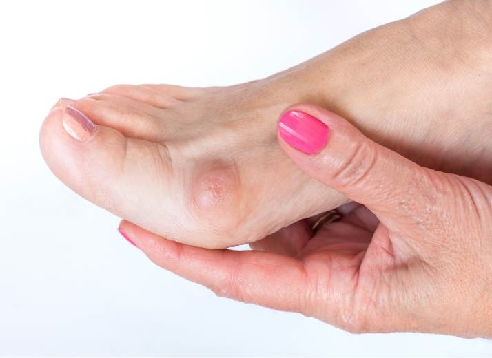 Bunion Splint: Relief and Support for Bunion Pain and Alignment Bunion Splint: Relief and Support for Bunion Pain and Alignment
