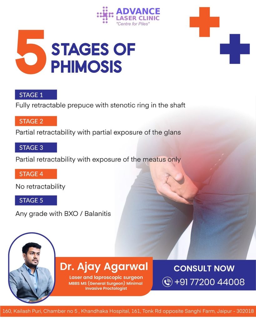 ZSR Circumcision doctor in Jaipur ZSR Circumcision doctor in Jaipur