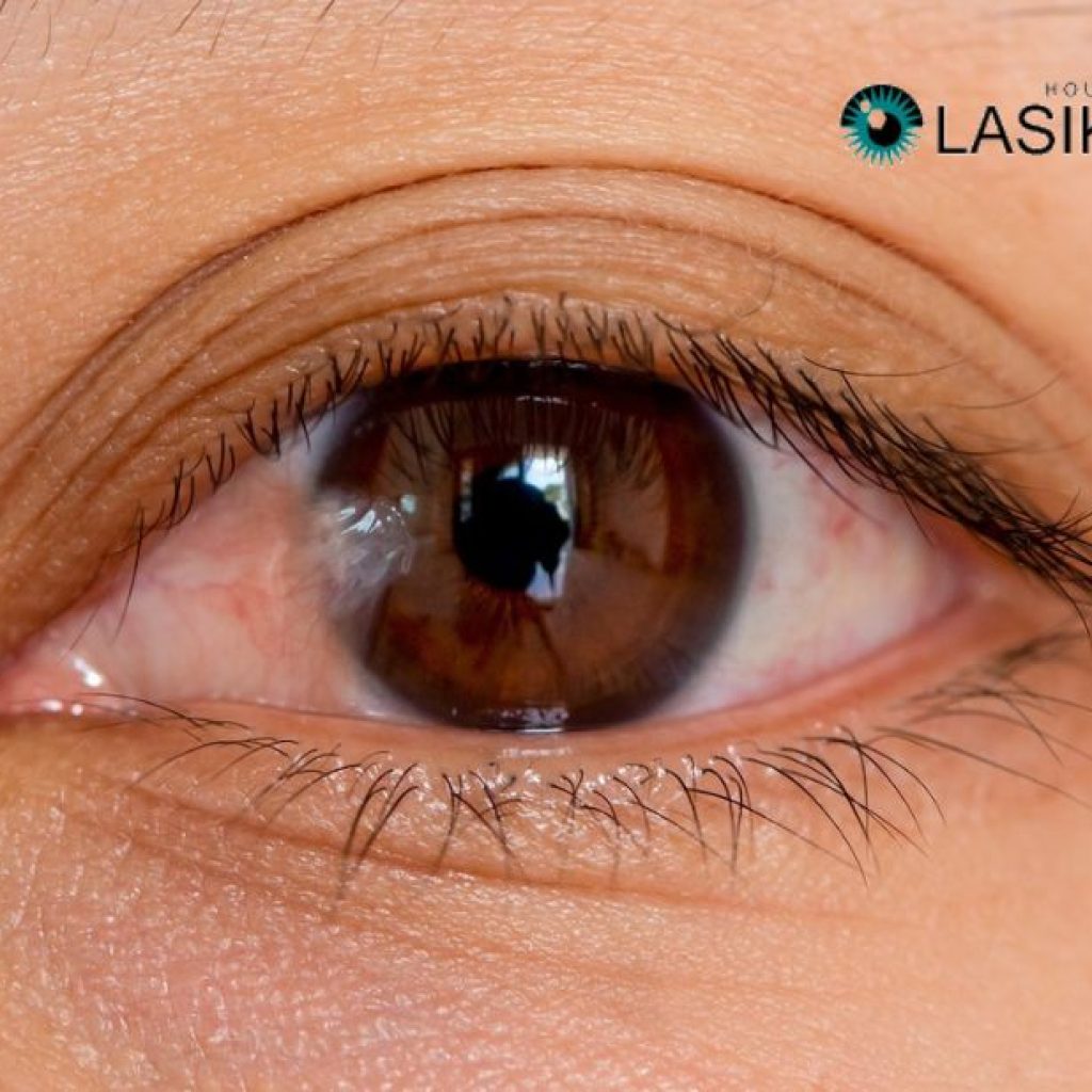 Pterygium: Understanding Causes, Treatments, and Prevention