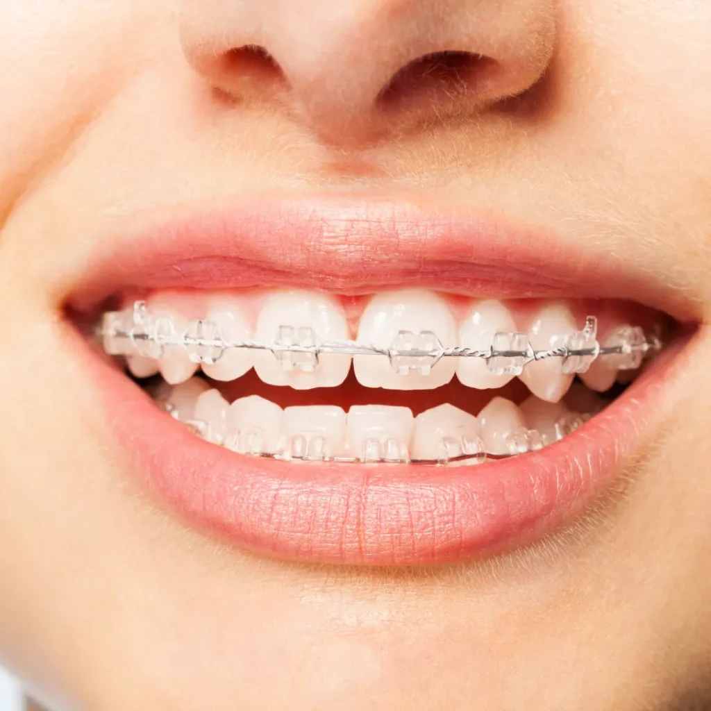 Understanding Typical Prices for Orthodontic Braces