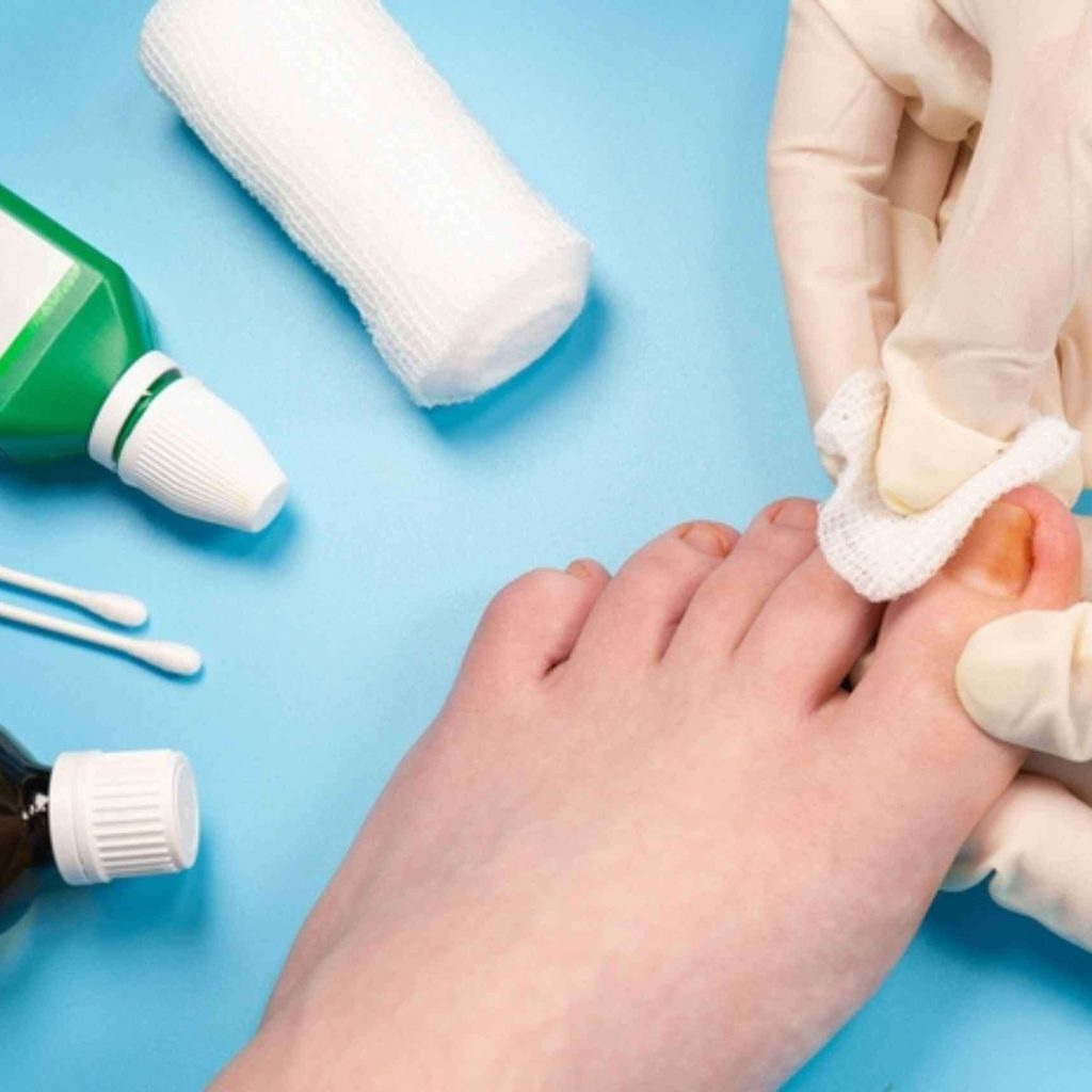 Expert Foot Care for Ingrown Toenails and Fungal Infections
