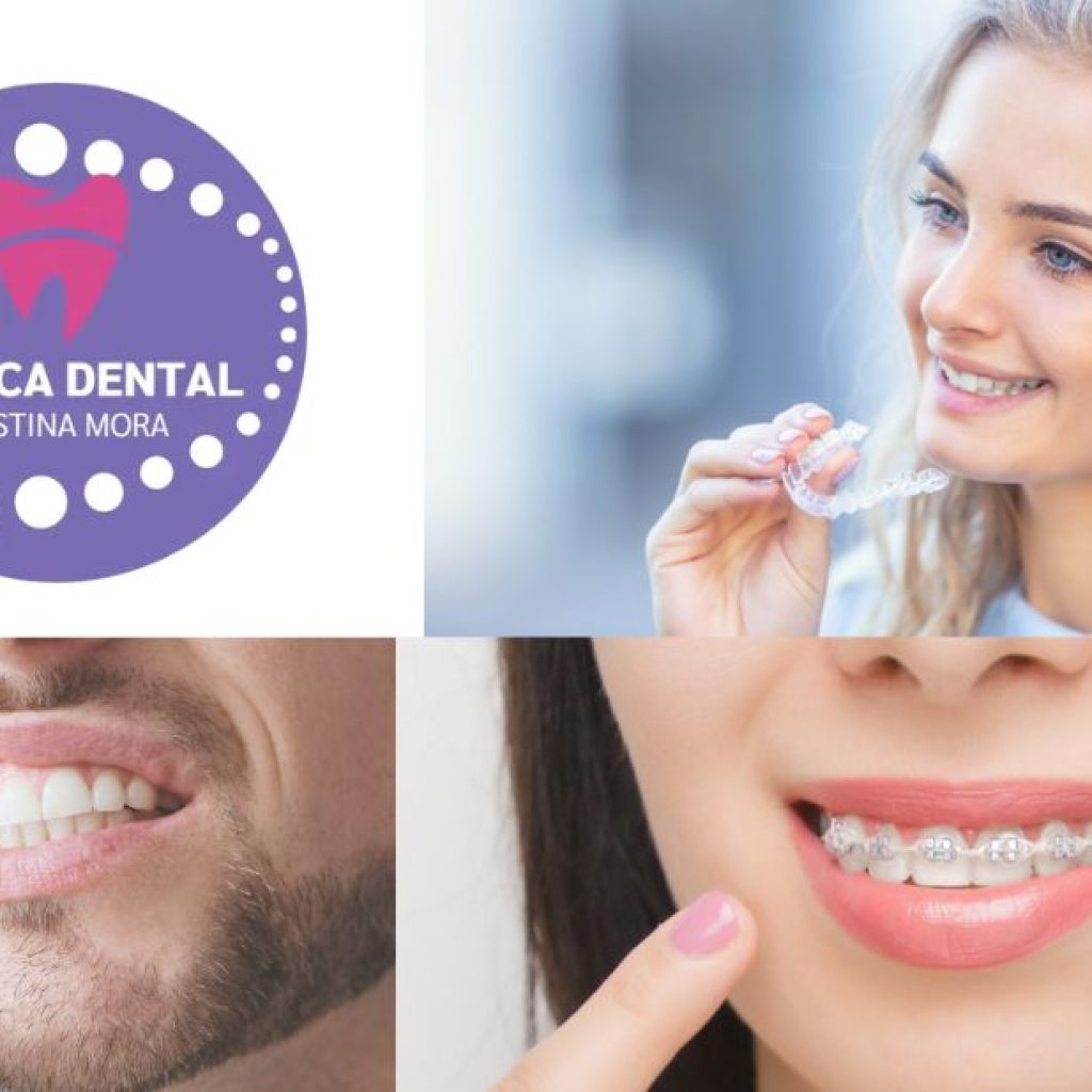Senyals clars de cures d’ortodòncia amb brackets a Gines Senyals clars de cures d’ortodòncia amb brackets a Gines