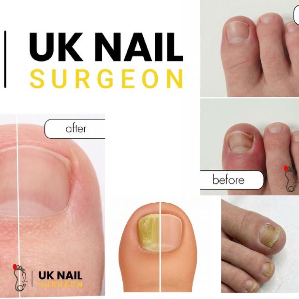 Relieving ingrown toenails: practical guide and treatment options Relieving ingrown toenails: practical guide and treatment options