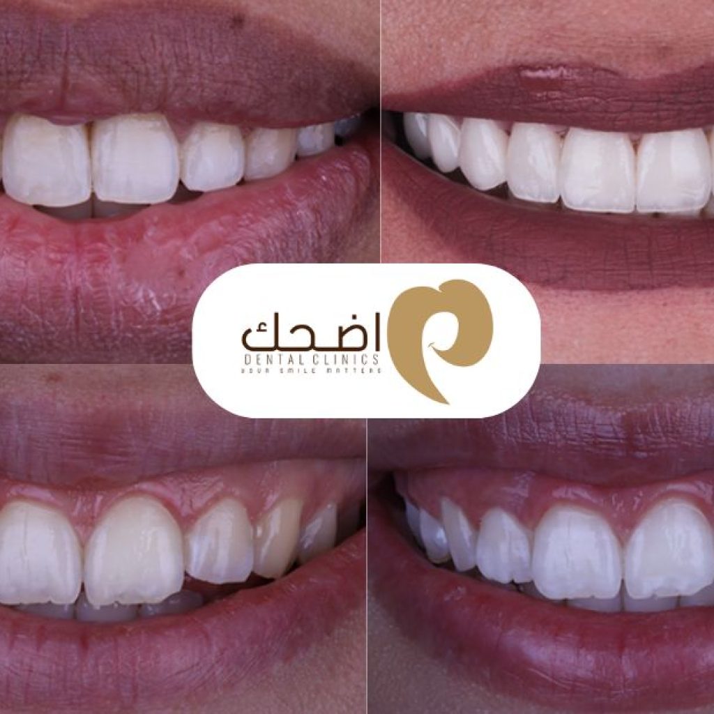 دليل أسعار زراعة الأسنان في بنها: خياراتك الصحية والموثوقة دليل أسعار زراعة الأسنان في بنها: خياراتك الصحية والموثوقة