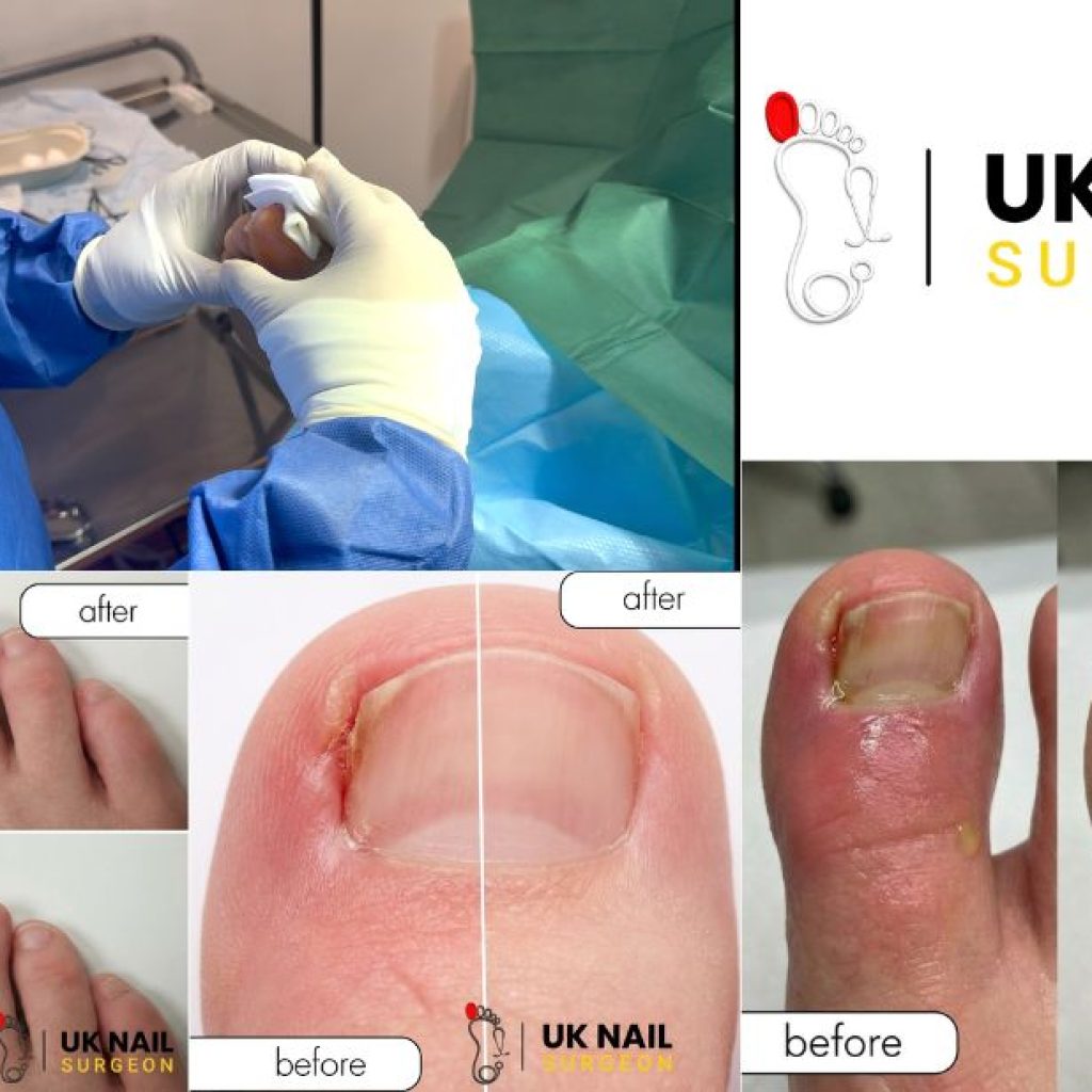 Gentle care for troublesome toe nails in children Gentle care for troublesome toe nails in children
