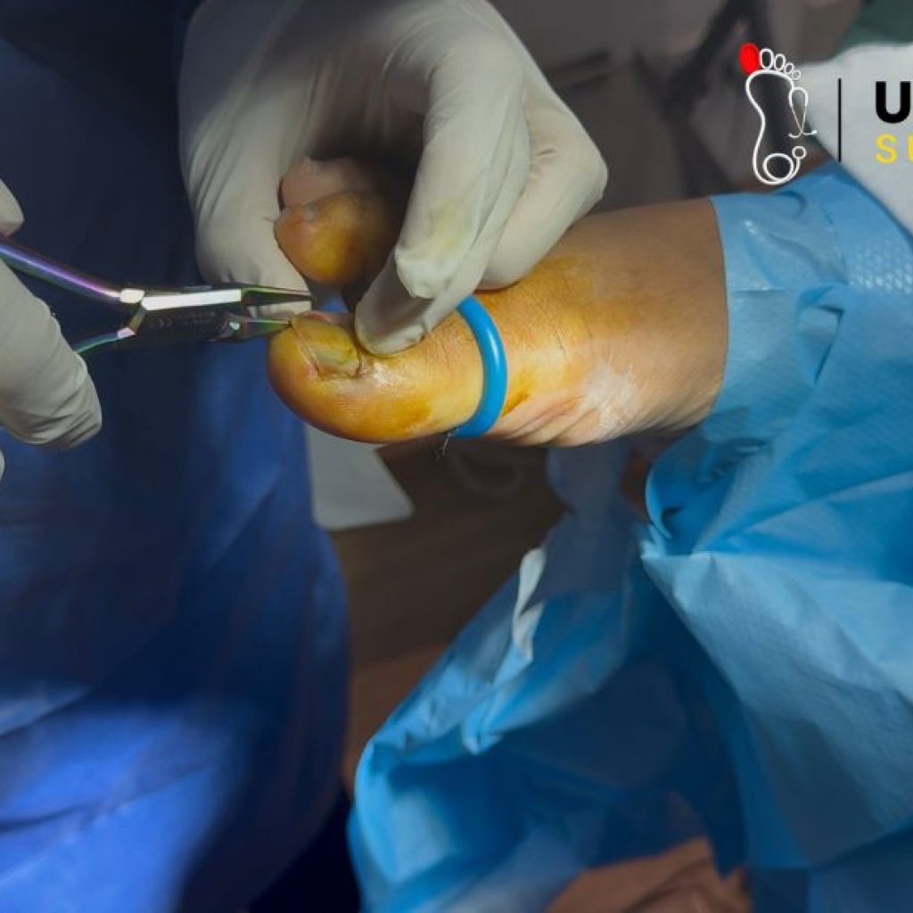 Relief for Painful Toenails: Quick, Safe Care and Recovery
