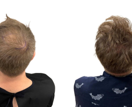 Natural Crown Hair Transplant in Turkey – UniquEra Clinic